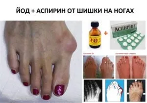 Мазь від кісточки на великому пальці ноги - вибір кращої (пальці) Мазь від кісточки на великому пальці ноги - вибір кращої