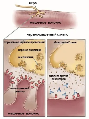 Міастенія - симптоми і лікування, форми захворювання (очна, генералізована, гравіс) (лікування) Міастенія - симптоми і лікування, форми захворювання (очна, генералізована, гравіс)