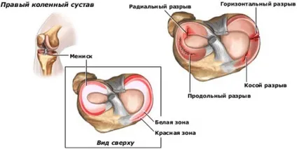 Меніскопатія симптоми і лікування хронічної про гострої меніскопатія колінного суглоба (симптоми) Меніскопатія симптоми і лікування хронічної про гострої меніскопатія колінного суглоба
