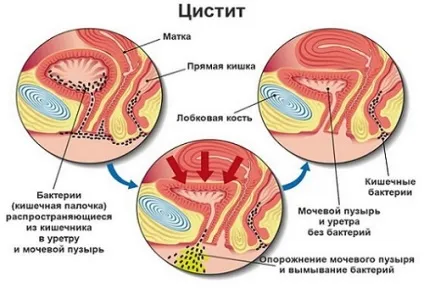 Метронідазол в гінекології докладна інструкція із застосування (гінекології) Метронідазол в гінекології докладна інструкція із застосування