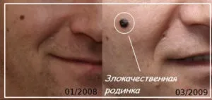 Як відрізнити родимку від меланоми - фото, особливості, ознаки появи (меланоми) Як відрізнити родимку від меланоми - фото, особливості, ознаки появи