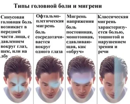 Мігрень, лікування