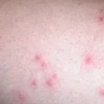 Як запобігти появі врослого волосся на тілі (як позбутися від врослого волосся) Як запобігти появі врослого волосся на тілі