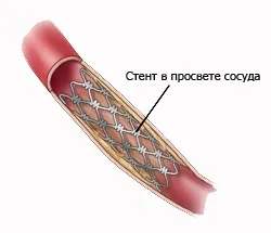 Як проводиться стентування нирки, і в яких ситуаціях потрібно дана операція (стентування) Як проводиться стентування нирки, і в яких ситуаціях потрібно дана операція