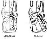 Як самостійно визначити чи є плоскостопість