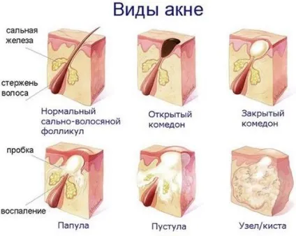 Як прибрати прищі на спині і плечах швидко в домашніх умовах (на) Як прибрати прищі на спині і плечах швидко в домашніх умовах