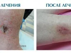 Як виглядає трофічна виразка на фото (виразка) Як виглядає трофічна виразка на фото