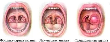 Як виглядає ангіна гнійна, фолікулярна, герпесная (як виглядає ангіна в горлі фото) Як виглядає ангіна гнійна, фолікулярна, герпесная