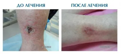 Як виглядає трофічна виразка на фото (трофічної виразки можливо) Як виглядає трофічна виразка на фото