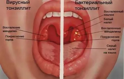 Як виглядає ангіна гнійна, фолікулярна, герпесная (ангіна) Як виглядає ангіна гнійна, фолікулярна, герпесная
