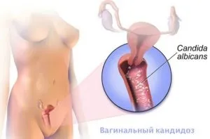 Чи можна завагітніти при молочниці ризик при зачатті і плануванні вагітності (завагітніти) Чи можна завагітніти при молочниці ризик при зачатті і плануванні вагітності