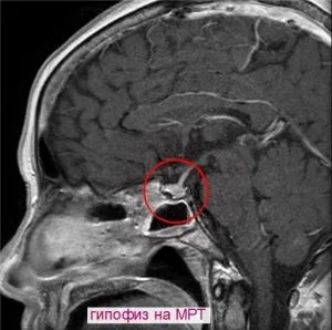 Мрт гіпофіза з контрастом що показує, підготовка