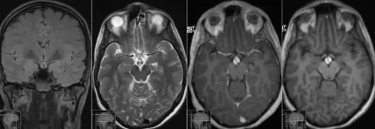 Мрт гіпофіза з контрастом що показує, підготовка