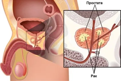 Мрт малого таза у чоловіків що показує, підготовка (малого) Мрт малого таза у чоловіків що показує, підготовка