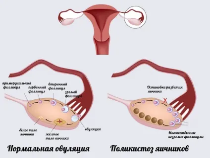 Мультіфоллікулярная структура яєчників причини і лікування (можна тільки після) Мультіфоллікулярная структура яєчників причини і лікування