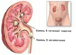 Камені в сечоводі лікування народними засобами захворювання сечовивідних шляхів (камені) Камені в сечоводі лікування народними засобами захворювання сечовивідних шляхів