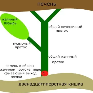 Камені в жовчних протоках, лікування народними засобами (камені) Камені в жовчних протоках, лікування народними засобами