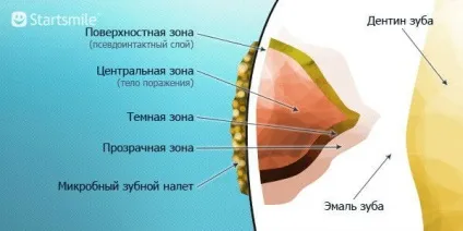 карієс зубів