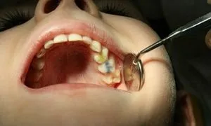 До чого сниться вирвати собі зуб без болю (вирвати) До чого сниться вирвати собі зуб без болю
