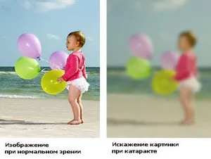 Катаракта - причини і симптоми