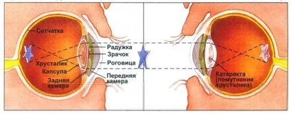 Катаракта причини, симптоми, методи лікування катаракти (методи) Катаракта причини, симптоми, методи лікування катаракти