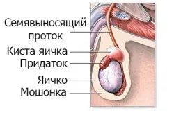 Кіста лівого придатка яєчка усунення та профілактика (лівого) Кіста лівого придатка яєчка усунення та профілактика