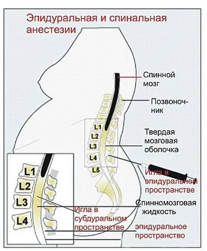 Кесарів розтин при пологах хід операції, анестезія, ускладнення, наслідки кесарева (знеболення) Кесарів розтин при пологах хід операції, анестезія, ускладнення, наслідки кесарева
