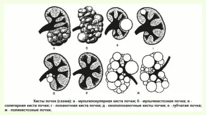 Кіста лівої нирки лікування (кіста) Кіста лівої нирки лікування