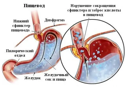 Кислий присмак у роті - що означає, причини, як позбутися (кислий) Кислий присмак у роті - що означає, причини, як позбутися