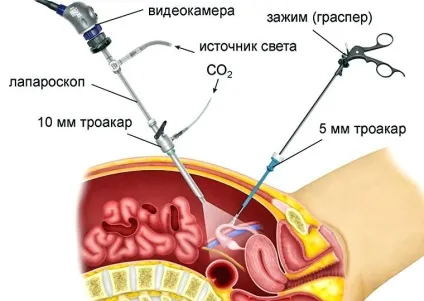 Кіста сечового міхура у жінок і чоловіків симптоми і лікування (жінок) Кіста сечового міхура у жінок і чоловіків симптоми і лікування