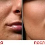 кавовий пілінг