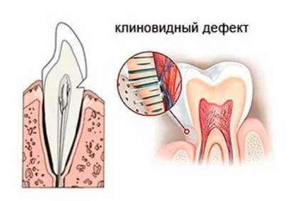 Клиновидний дефект зубів що потрібно знати про лікування