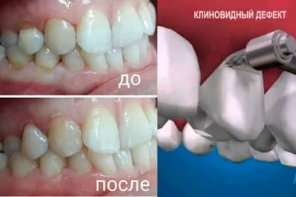 Клиновидний дефект зубів що потрібно знати про лікування
