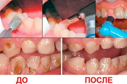 Клиновидний дефект зубів що потрібно знати про лікування