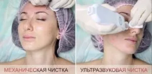 Комбінована (комплексна) чистка обличчя (чистка) Комбінована (комплексна) чистка обличчя