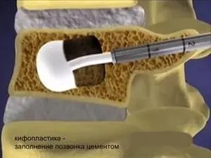 Компресійний перелом поперекового відділу хребта (перелом) Компресійний перелом поперекового відділу хребта