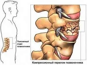 Компресійний перелом поперекового відділу хребта (компресійний) Компресійний перелом поперекового відділу хребта