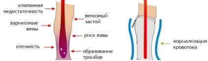 Компресійні гольфи при варикозі для чоловіків і жінок як підібрати, інструкція із застосування