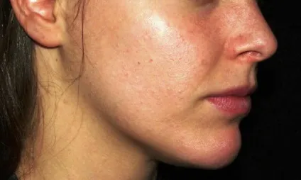 Комбінована чистка обличчя як робиться, протипоказання відгуки та фото (протипоказання) Комбінована чистка обличчя як робиться, протипоказання відгуки та фото