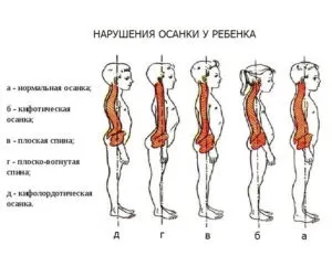 Порушення постави у дитини профілактика ісправленіемама - доктор
