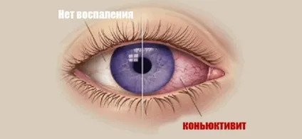 Кон'юнктивіт - лікування хвороби (енциклопедія хвороб) Кон'юнктивіт - лікування хвороби