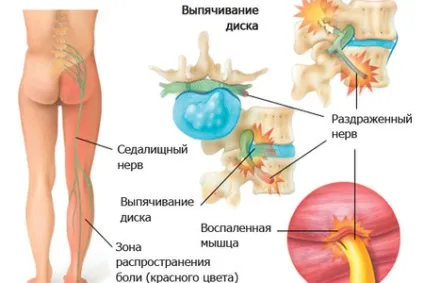 Корінцевий синдром поперекового відділу симптоми лікування