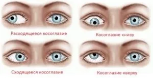 Косоокість у дітей причини, лікування і профілактика (лікування) Косоокість у дітей причини, лікування і профілактика