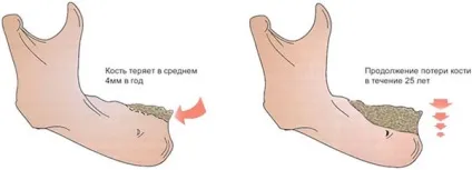 Кісткова резорбція види і лікування (види) Кісткова резорбція види і лікування