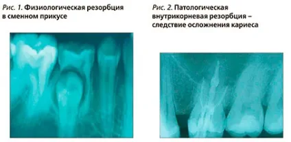 Кісткова резорбція види і лікування (кісткова резорбція) Кісткова резорбція види і лікування