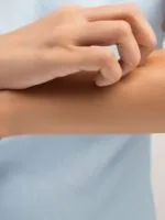 Кропив'янка на обличчі