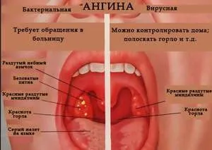 Червоне горло у дитини як визначити хворобу і чим її лікувати (червоне) Червоне горло у дитини як визначити хворобу і чим її лікувати