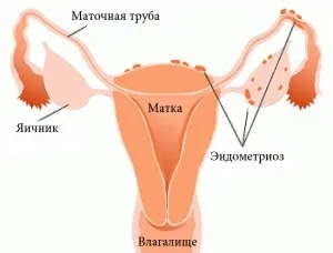 Червона щітка при міомі і ендометріозі відгуки лікарів (ендометріоз) Червона щітка при міомі і ендометріозі відгуки лікарів