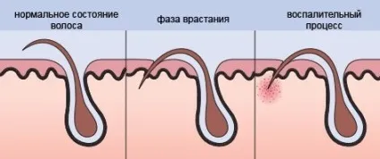 Крем від врослого волосся