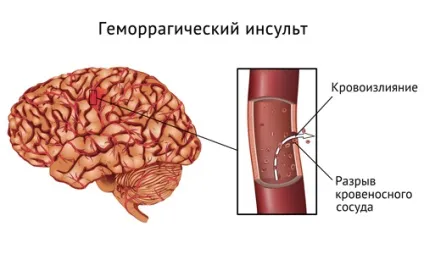 Крововилив в мозок наслідки, причини, лікування (відео) (лікування) Крововилив в мозок наслідки, причини, лікування (відео)